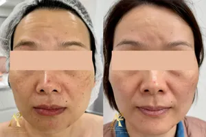 Résultat avant/après traitement anti-âge - exemple client 1