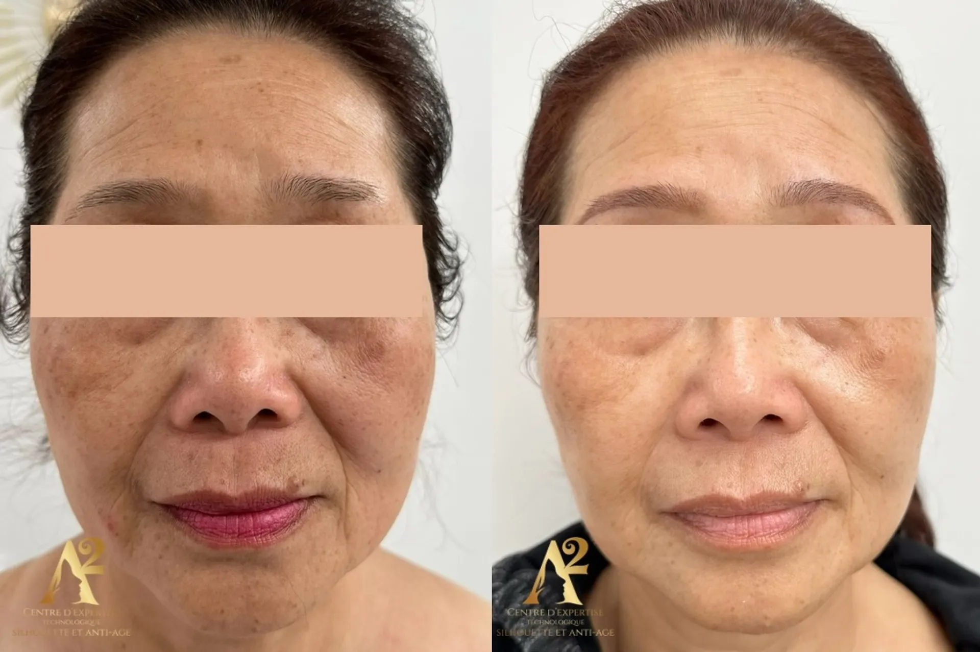 Résultat avant/après traitement anti-âge - exemple client 2