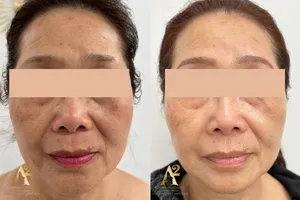 Résultat avant/après traitement anti-âge - exemple client 2