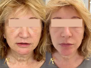 Résultat avant/après traitement anti-âge - exemple client 4