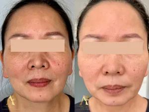 Résultat avant/après traitement anti-âge - exemple client 8