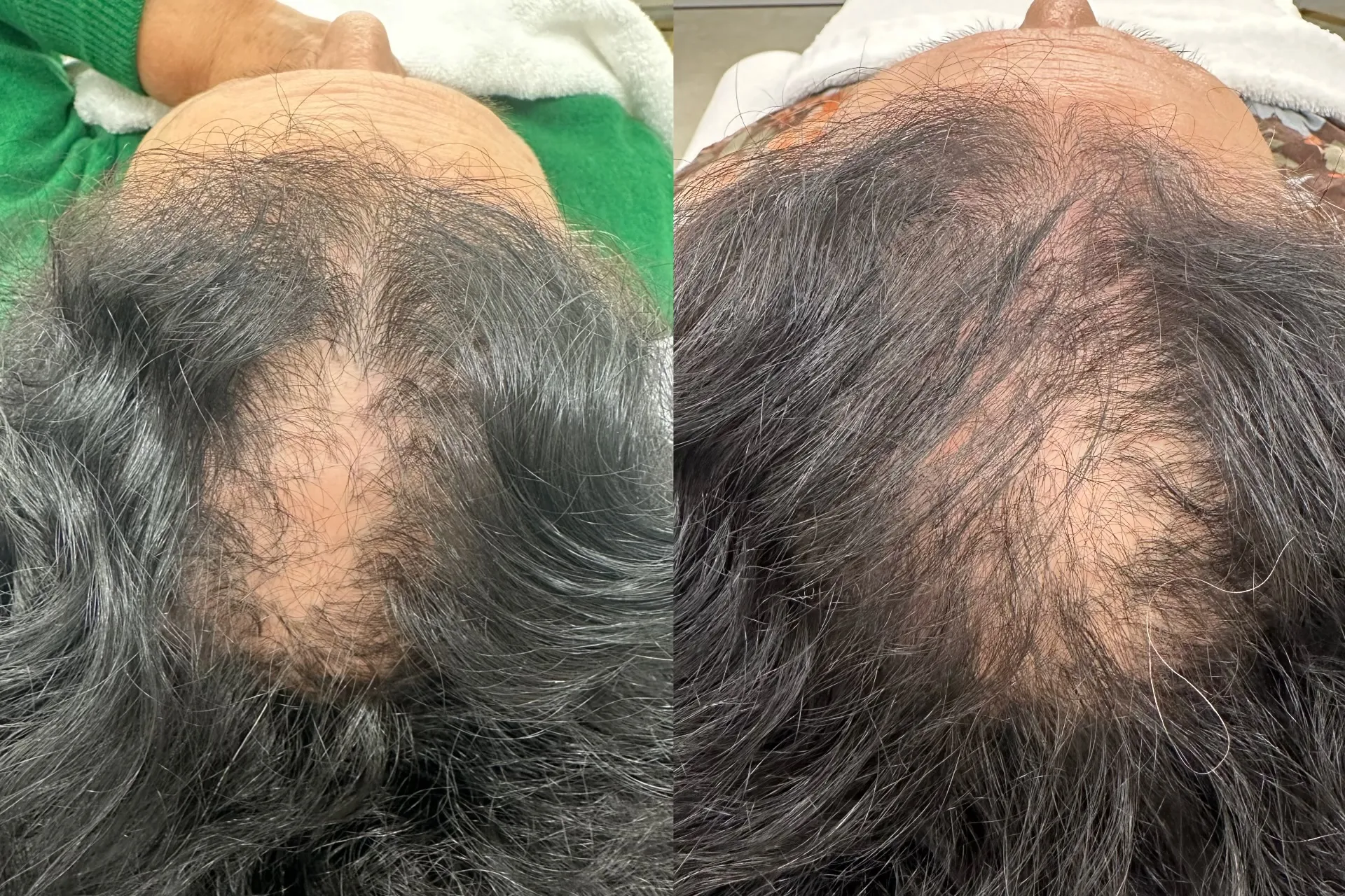 Résultat avant/après traitement capillaire - amélioration visible de la densité des cheveux et réduction de la calvitie